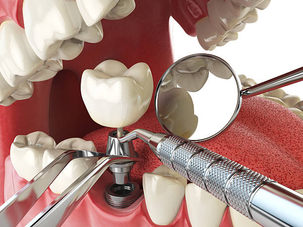 Best Emergency Denture Repair in Columbus, WI